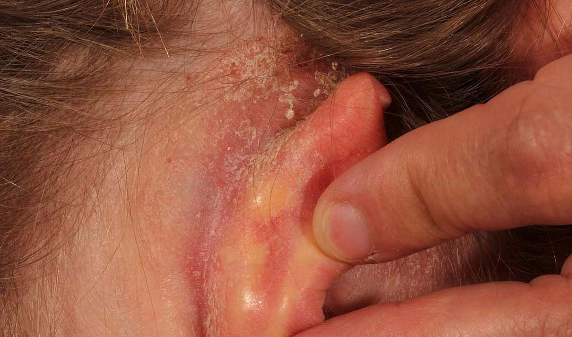 Ear eczema