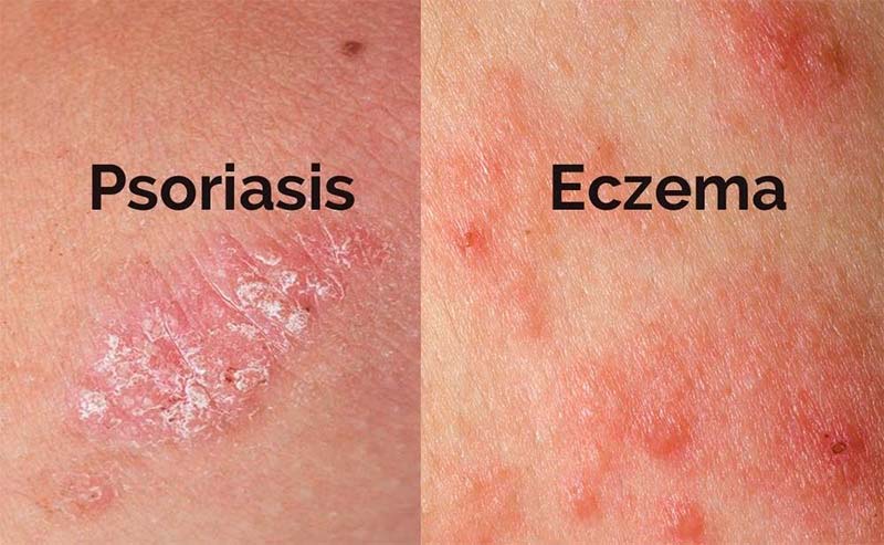 What's the Difference Between Psoriasis & Eczema?