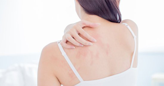 Dry Skin and Eczema
