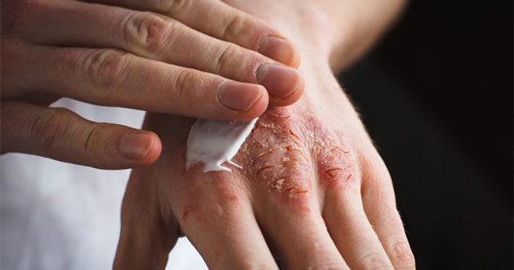 Infection and Eczema